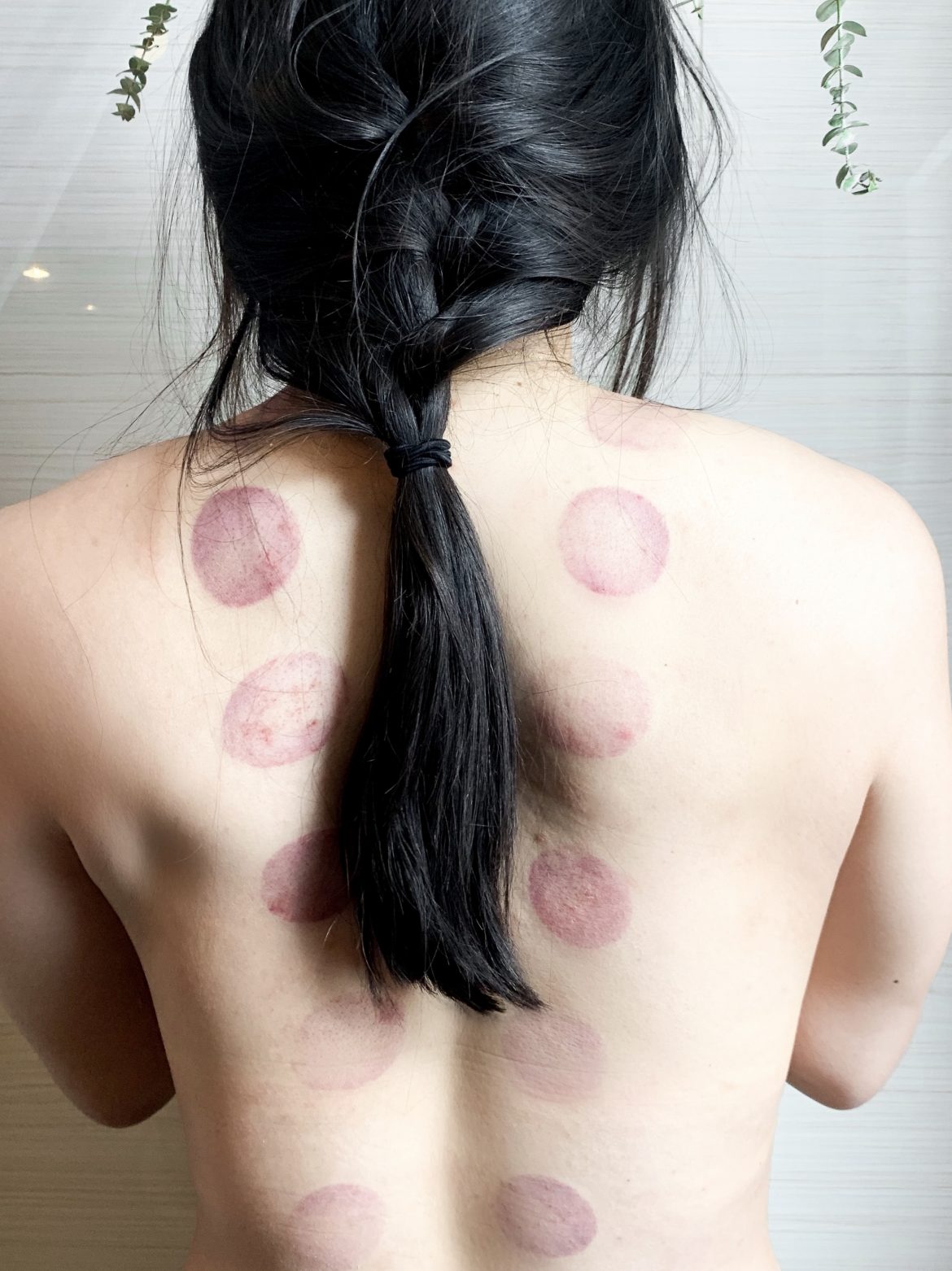 Acupuncture & Cupping for Pole Athletes